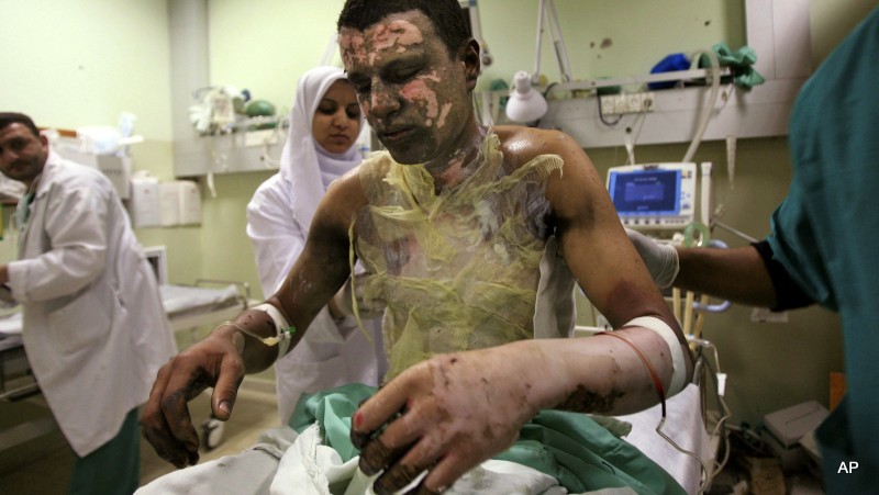 Palestinian Akram Abu Roka is treated for white phosphorous burns