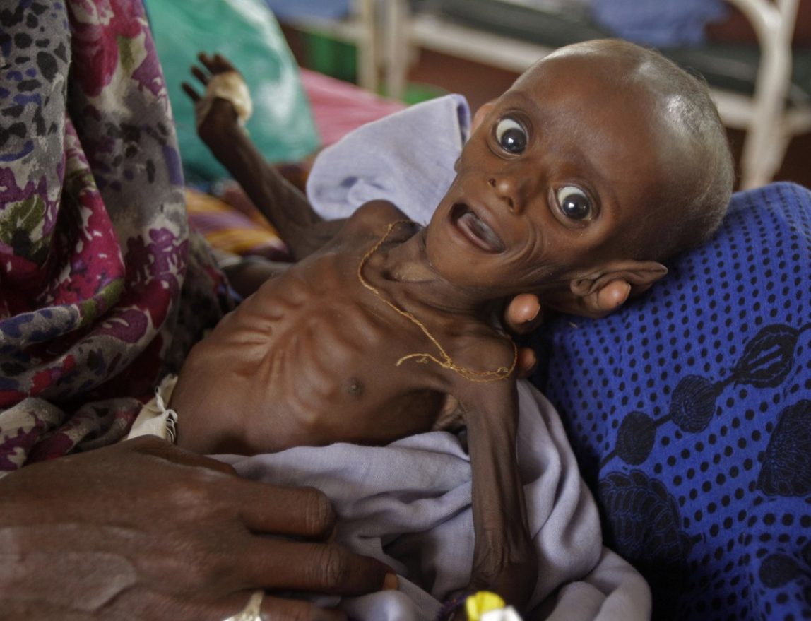 1 in 4 children malnourished, global report says