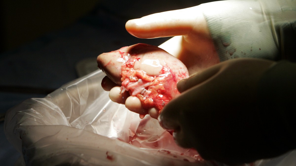 A doctor readies a kidney for transplant Thursday, Feb. 21, 2008 in Atlanta. (AP Photo/John Bazemore)