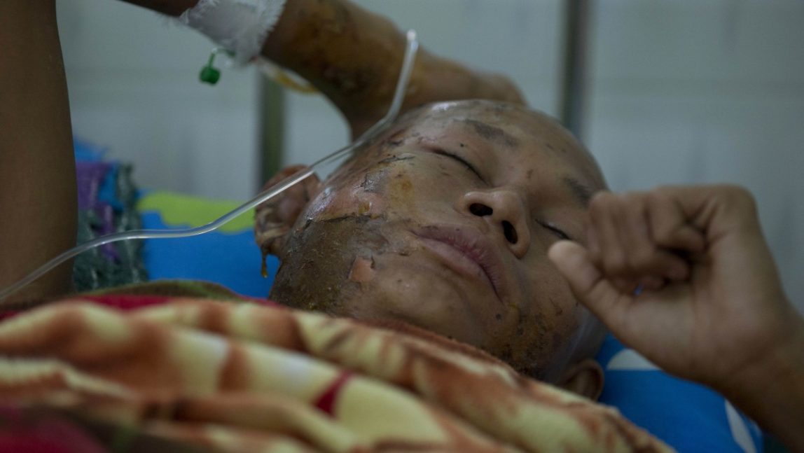 A Buddhist monk with burn injuries lies in a hospital bed in Monywa town shop, northwestern Myanmar, Thursday, Nov 29, 2012. (AP Photo/Gemunu Amarasinghe)