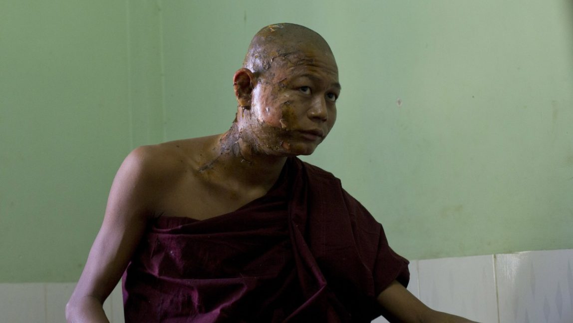 A Buddhist monks with burn injuries sits in his hospital bed in Monywa town shop, northwestern Myanmar, Thursday, Nov 29, 2012. (AP Photo/Gemunu Amarasinghe)