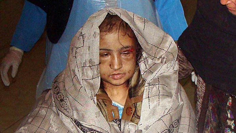 In this Wednesday, Dec. 28, 2011 file photo, 15-year-old Sahar Gul, is carried into hospital in Baghlan north of Kabul, Afghanistan. (AP Photo/Jawed Basharat, File)