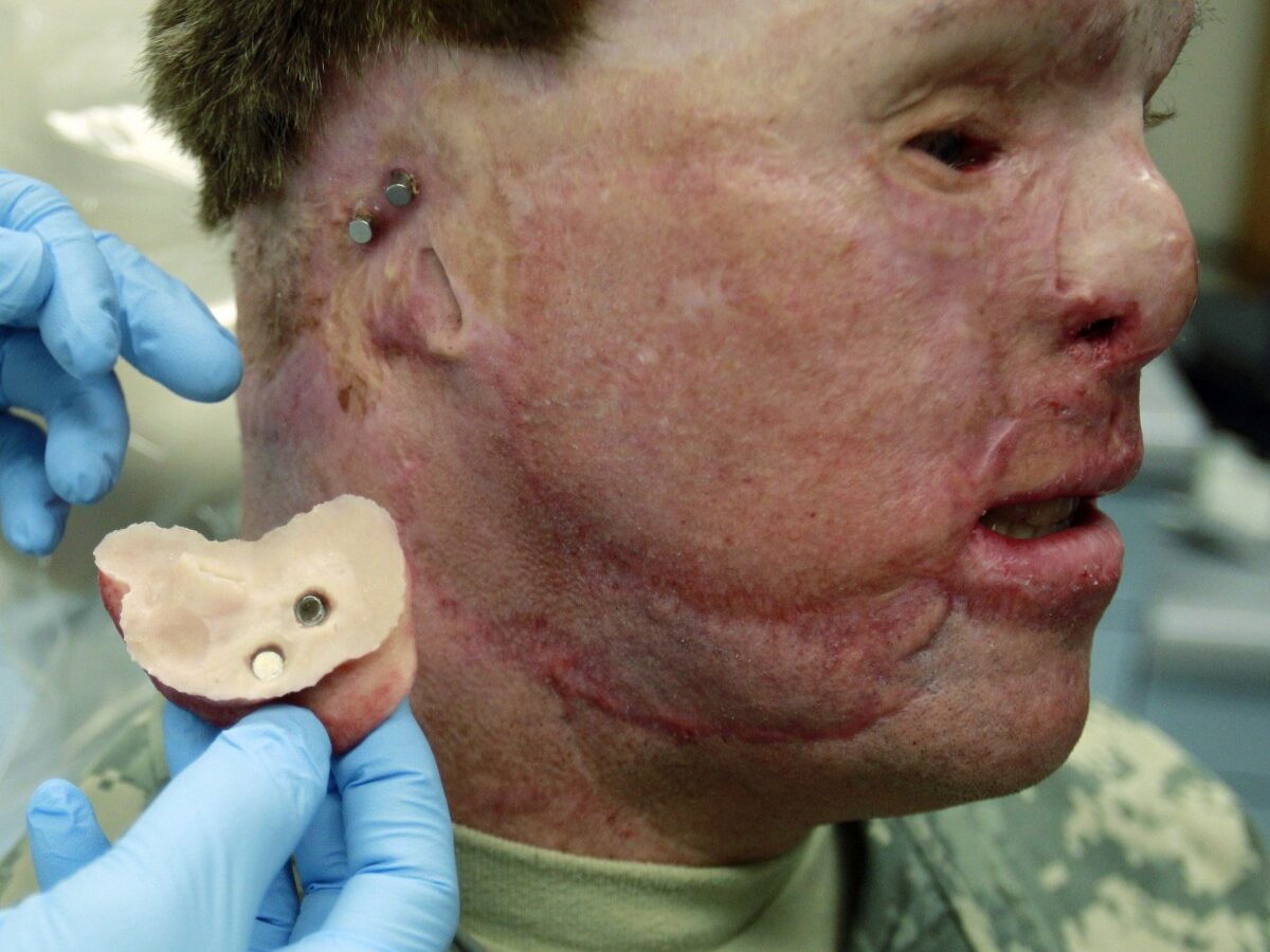 In this June 23, 2010 photo, Master Sgt. Todd Nelson sits for Dr. Joe Villalobos as he makes adjustments to a prosthetics ear at Wilford Hall Medical Center in San Antonio. (AP Photo/Eric Gay)