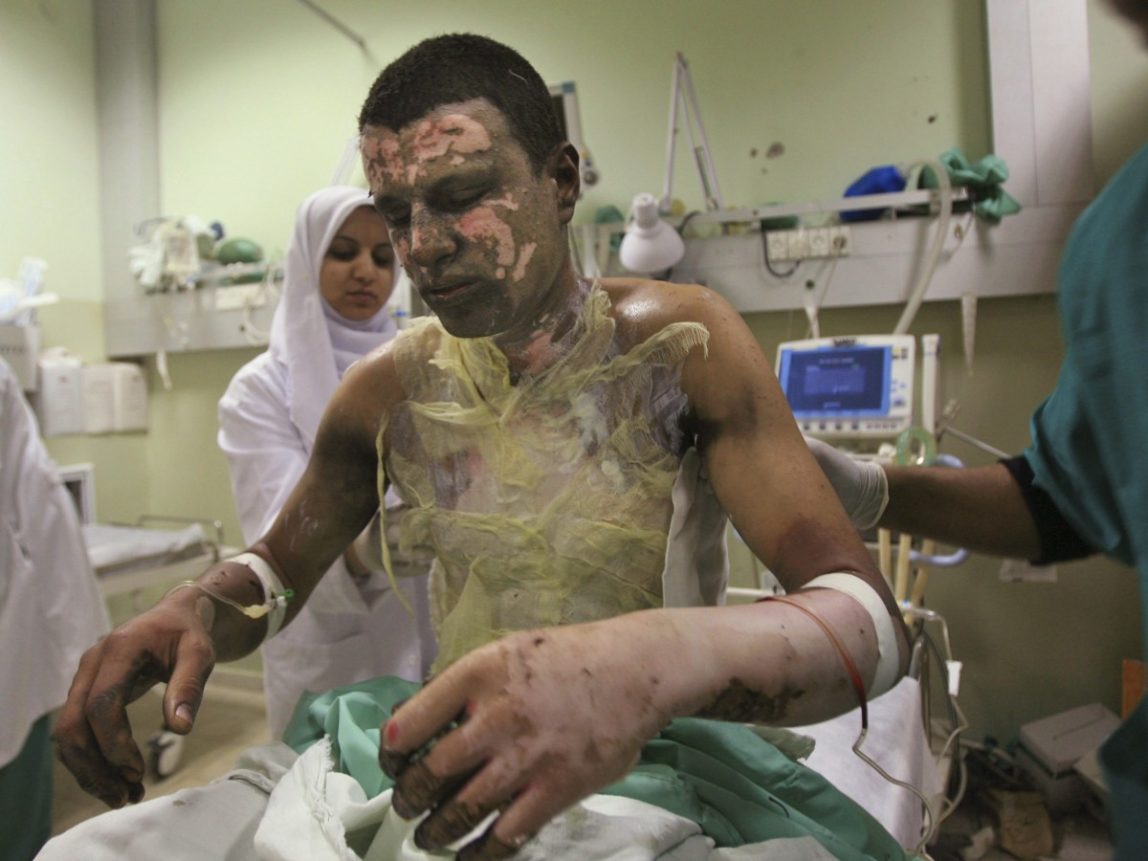 Palestinian Akram Abu Roka is treated for burns caused by munitions containing white phosphorus used by Israel. The US has admitted to supplying white phosphorus to Saudi Arabia. (AP Photo/Eyad Baba)