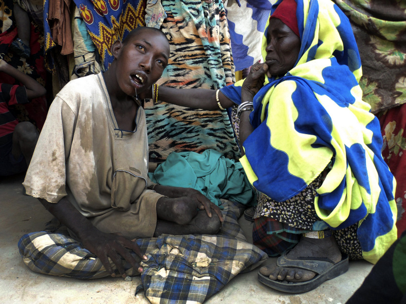 An underfed Ethiopian Somali boy with polio