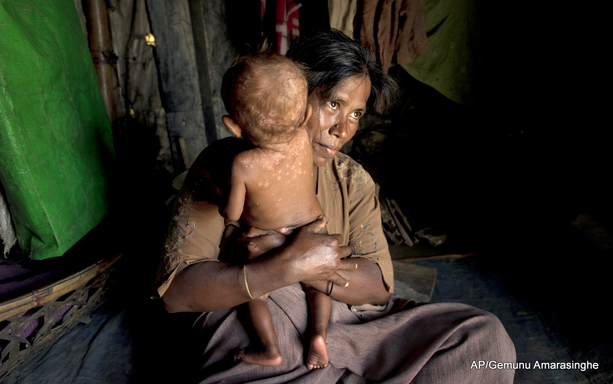 A Rohingya refugee holds her daughter who suffers from a skin disease in their makeshift tent at Dar Paing camp, north of Sittwe, Rakhine state, Myanmar. The authorities in Myanmar's Rakhine state, where mobs disrupted aid operations for displaced Rohingya Muslims, say international aid organizations that withdrew from the area in April are welcome to return, specifically the group Doctors without Borders, which had been kicked out in February 2014 after it publicized cases of alleged attacks on Rohingyas.
