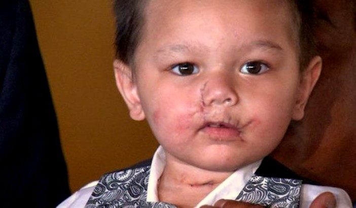 No Charges For Police Who Disfigured Toddler With Grenade During Negligent Drug Raid