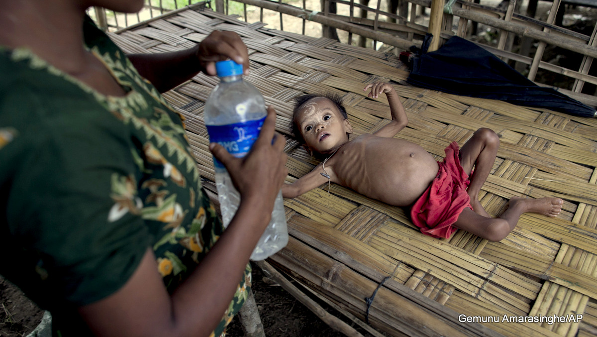Myanmar Malnourished Rohingya