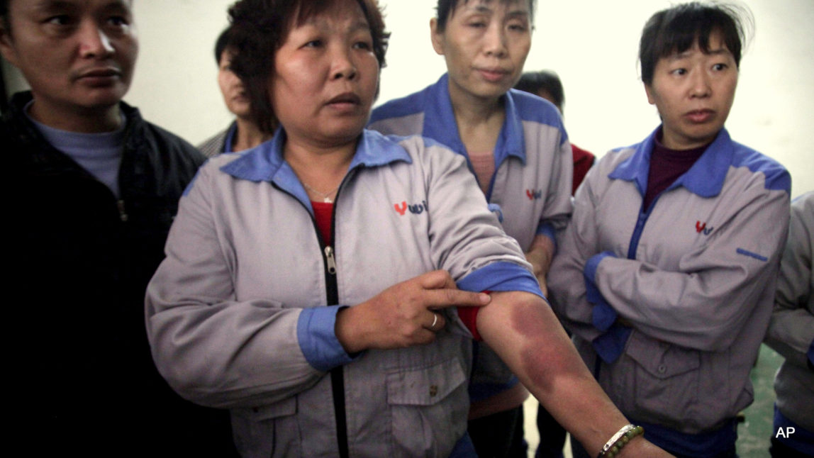 In this March 26, 2015 photo, one of workers shows bruises which she says were caused by police as they moved to suppress a demonstration by workers two days earlier, inside the Cuiheng Handbag Factory in Nanlang township in Zhongshan city in southern China's Guangdong Province. A Nanlang government statement said it dispatched a team March 24 to persuade the workers to return to work, but that some of them were flattening tires, destroying a surveillance camera, displaying banners and preventing other workers from returning to the workplace. Four workers were detained. Workers said they were holding a peaceful rally when police attacked them.