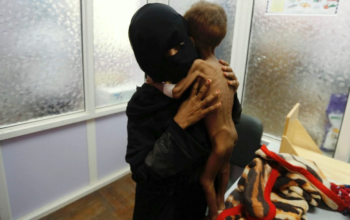 A woman brings her child to hospital in Yemen to be treated for severe acute malnutrition.