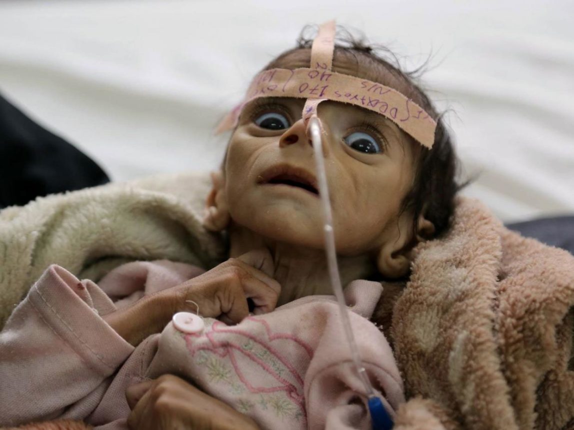 A child suffering severe acute malnutrition in a Yemeni hospital. (Photo: AP)