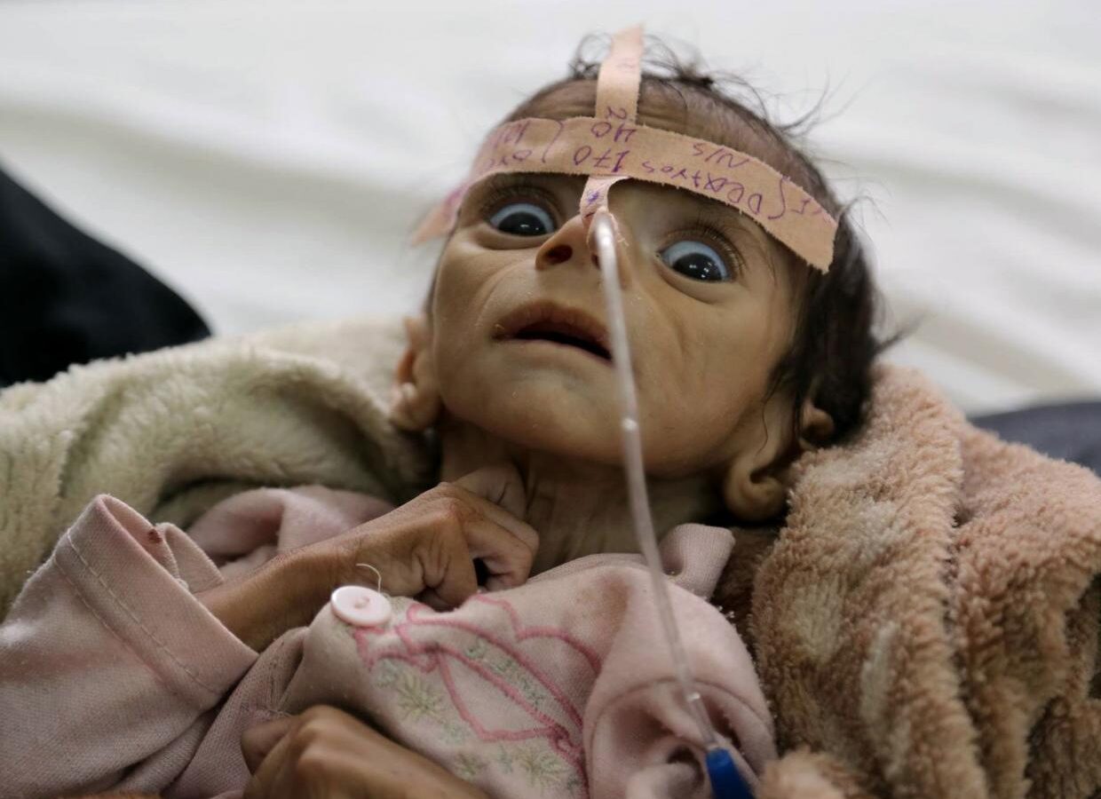 A child suffering severe acute malnutrition in a Yemeni hospital. (Photo: AP)