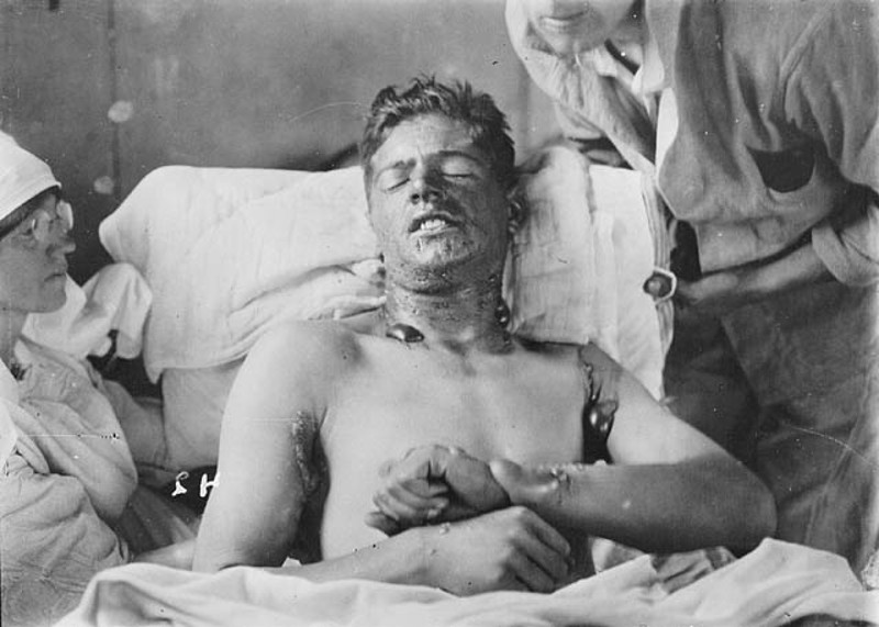 File: An unidentified Canadian soldier with mustard gas burns, photographed during World War I. (Wikimedia Commons)
