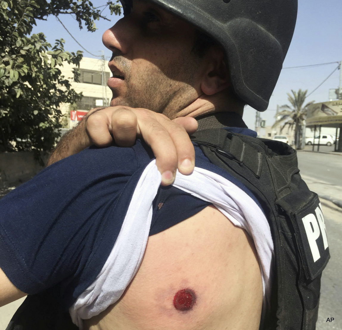 The Associated Press Photographer Majdi Mohammed shows a bruise after he was hit with a rubber bullet while covering clashes between Israeli forces and Palestinians in the town of al Ram, West Bank, Sunday, Oct. 9, 2016. Mohammed said that while he was covering the clashes, one of the Israelis cursed him and ordered him to leave. He said that as he turned around to leave, he was shot from close range in the back of his shoulder, an area that was not covered by his protective vest.