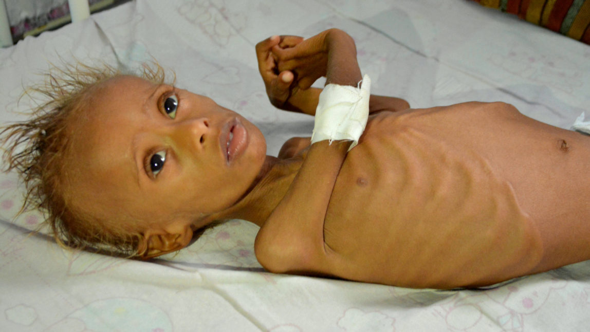 Salem, 5, who suffers from malnutrition, lies on a bed at a hospital in the port city of Hodeidah, southwest of Sanaa, Yemen. Even before the war, Hodeidah was one of the poorest cities in Yemen, the Arab world’s most impoverished nation. Now, the destruction of the port city’s fishing boats and infrastructure by Saudi-led airstrikes means the U.N. estimates 100,000 children in the province are at risk of severe malnutrition. (AP Photo)