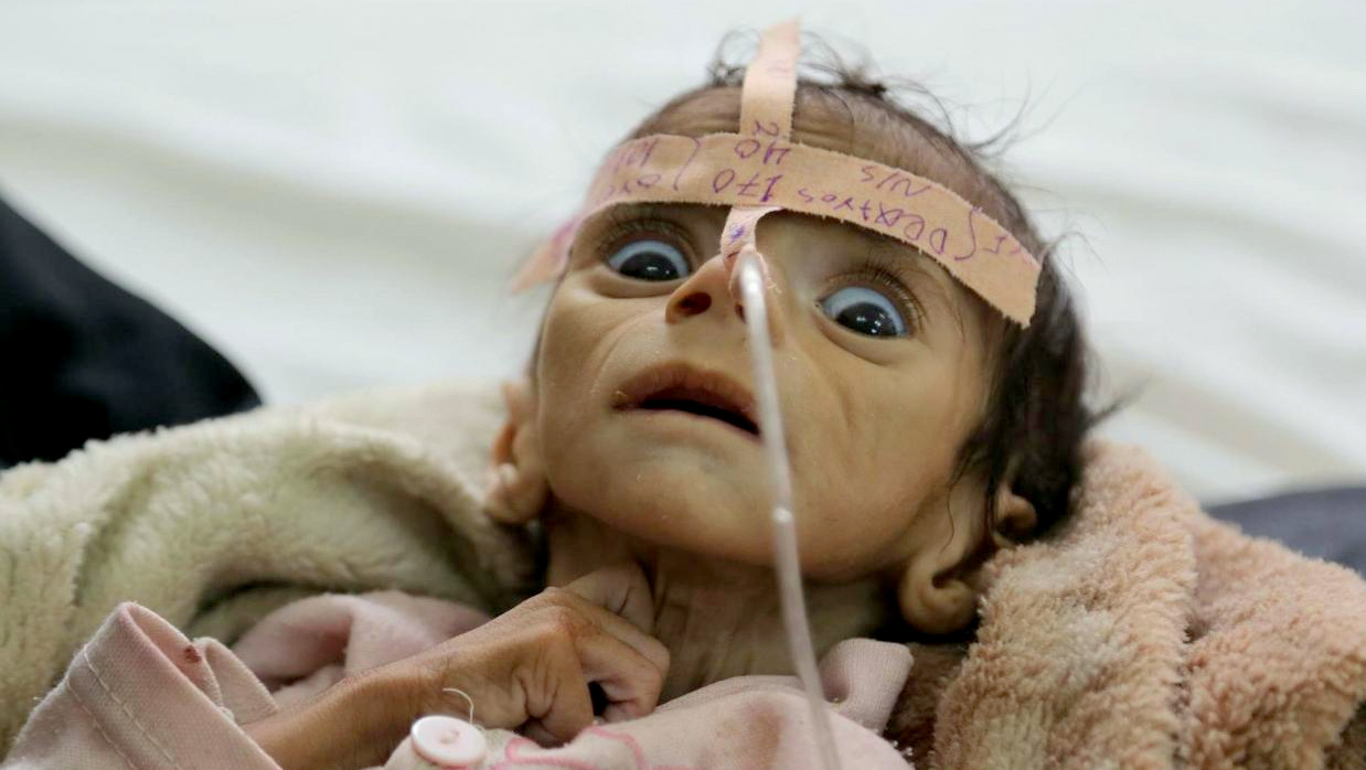 Udai Faisal, who is suffering from acute malnutrition, is hospitalized at Al-Sabeen Hospital in Sanaa, Yemen. Udai died not long after the photo was taken. Hunger has been the most horrific consequence of Yemen’s conflict and has spiraled since Saudi Arabia and its allies, backed by the U.S., launched a campaign of airstrikes and a naval blockade a year ago. (AP Photo/Maad al-Zikry, File)