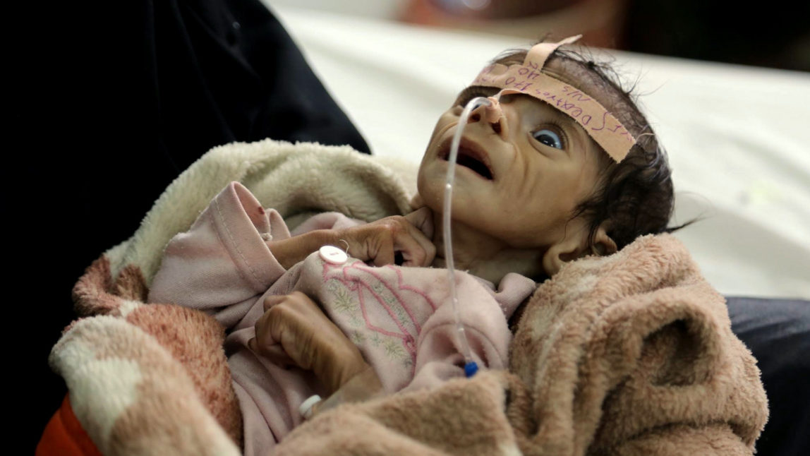 In this Tuesday, March 22, 2016 photo, infant Udai Faisal, who is suffering from acute malnutrition, is hospitalized at Al-Sabeen Hospital in Sanaa, Yemen. Udai died on March 24. Hunger has been the most horrific consequence of Yemen’s conflict and has spiraled since Saudi Arabia and its allies, backed by the U.S., launched a campaign of airstrikes and a naval blockade a year ago. (AP Photo/Maad al-Zikry)