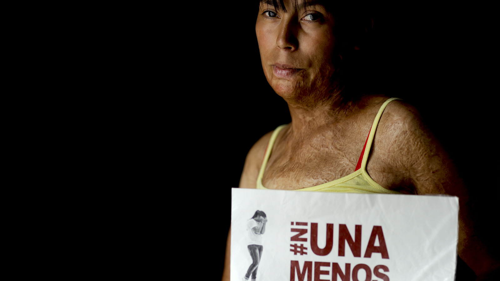In this Feb. 9, 2017 photo, Maira Maidana poses for a portrait with the name of the women's movement "Not one Less" in Buenos Aires, Argentina. Fifty-nine surgeries later, Maidana has finally found the courage to tell the truth about what happened to her the night her husband set her on fire. She says she owes that courage to a grassroots movement of tens of thousands of people across Argentina who have mobilized to fight violence against women. Called Ni Una Menos, or Not One Less, the movement has spread rapidly across the world. (AP/Natacha Pisarenko)