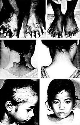 Photos show the results of radiation on a child taken before and after the Bravo test.