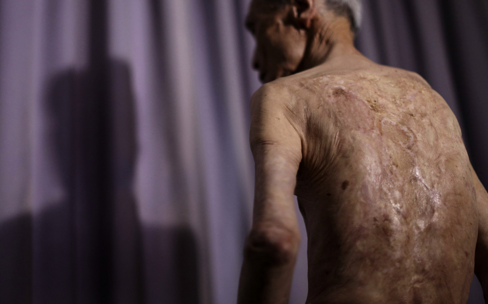 Sumiteru Taniguchi, a survivor of the 1945 atomic bombing of Nagasaki, shows his back with scars of burns from the atomic bomb explosion, during an interview at his office in Nagasaki, southern Japan, June 30, 2015. (AP/Eugene Hoshiko)