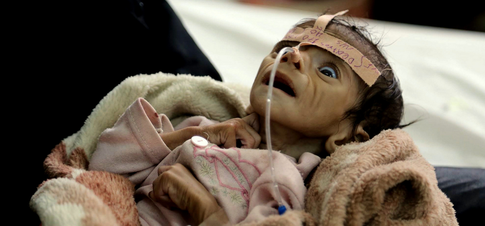 In this Tuesday, March 22, 2016 photo, infant Udai Faisal, who is suffering from acute malnutrition, is hospitalized at Al-Sabeen Hospital in Sanaa, Yemen. Udai died on March 24. Hunger has been the most horrific consequence of Yemen’s conflict and has spiraled since Saudi Arabia and its allies, backed by the U.S., launched a campaign of airstrikes and a naval blockade a year ago. (AP Photo/Maad al-Zikry)