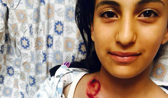 12 year-old Aseel Muheisen suffered a broken collarbone from a black, sponge-tipped plastic bullet used by Israeli police in Jerusalem. ( © Defense for Children Palestine)