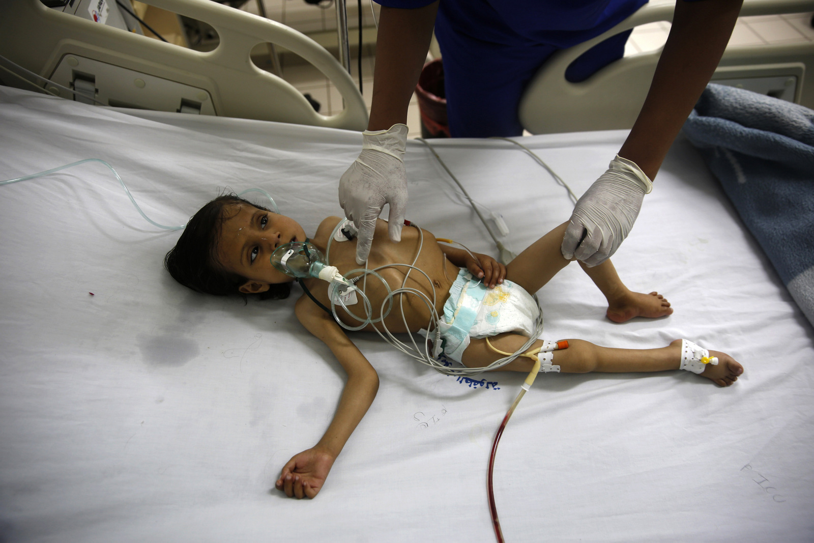 A nurse cares for a malnourished boy at Al-Sabeen hospital in Sanaa, Yemen. Hani Mohammed | AP