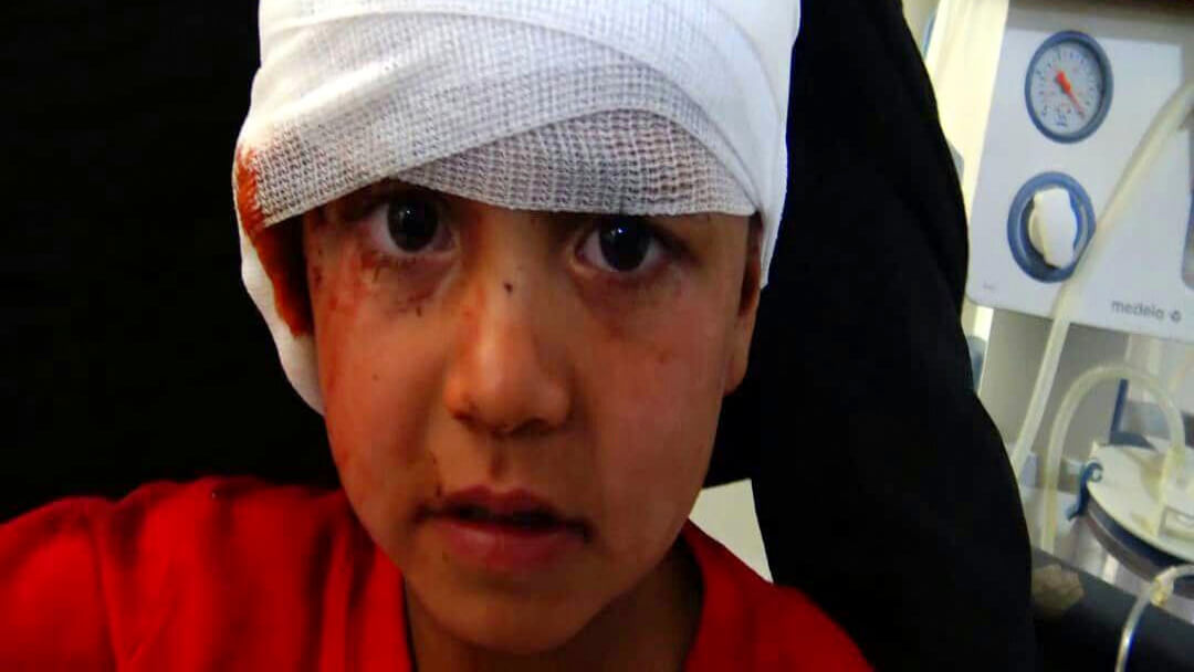 六岁的Ali Musfir Khamlan在Sadaa的Al Jomouri医院接受治疗。照片|艾哈迈德·阿卜杜勒·卡里姆