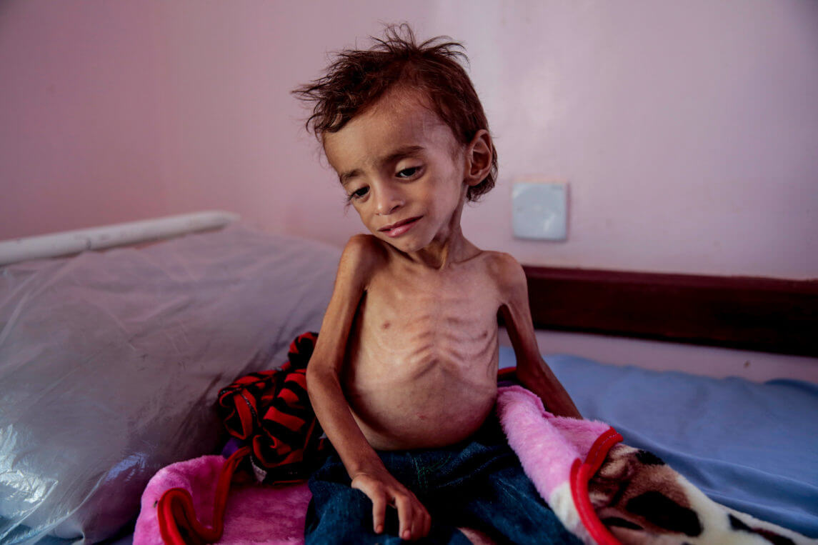 拯救儿童：也门有85,000名儿童可能已经死于饥饿