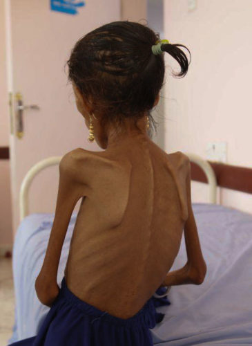 Yemen Famine feature photo