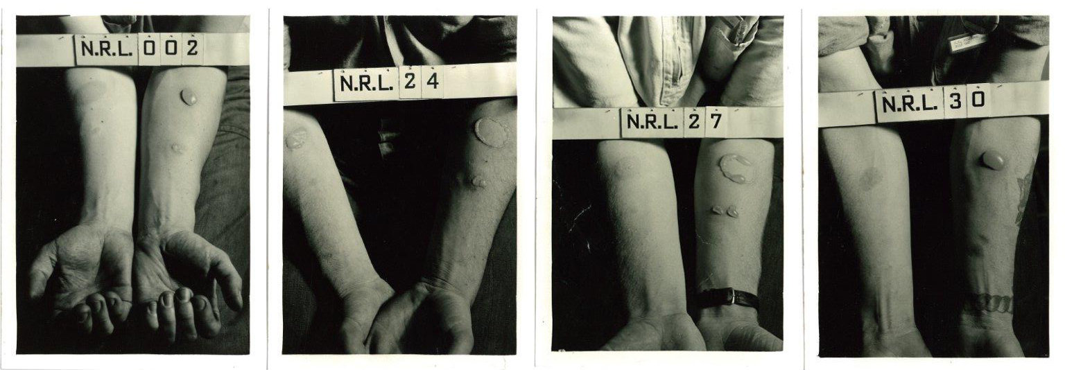 The forearms of human test subjects after being exposed to nitrogen mustard and lewisite agents at the Naval Research Lab in D.C. Photo | Public Domain