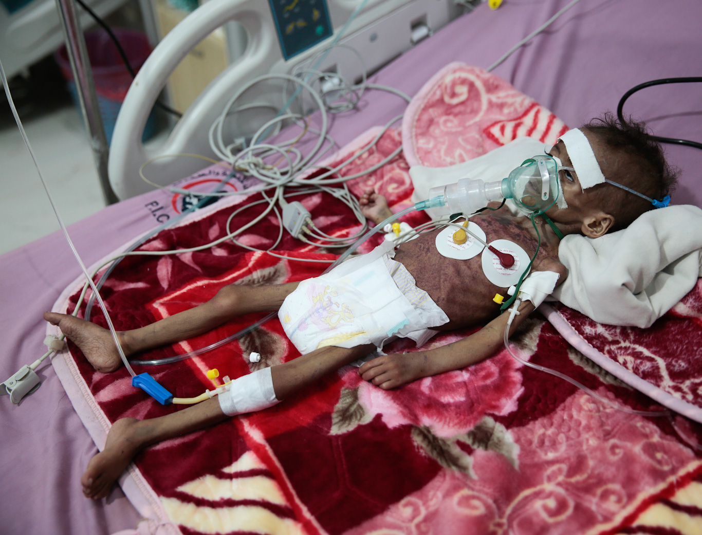 Yemen malnourished 